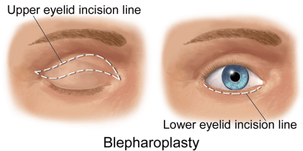 eyelid surgery diagram