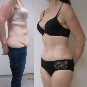 before and after tummy tuck