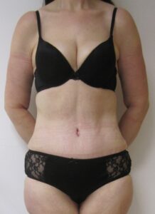 tummy tuck after 1