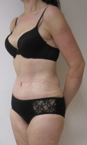 tummy tuck after 3