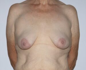 before breast augmentation surgery
